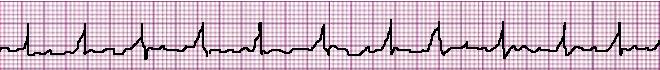 EKG-Vorhofflimmern