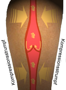 Wieder schließende Venenklappen (mit Kompressionsstrupf)